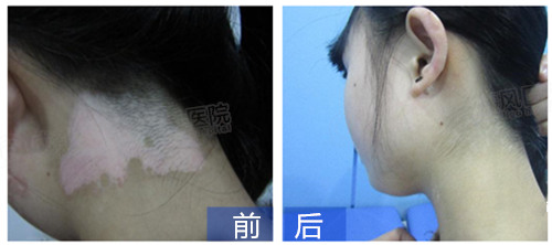 寒假去哪儿?给孩子一份祛白强化治疗,比起补课游玩更紧要! /uploads/allimg/20180117/68611516169712.jpg